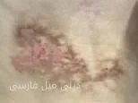 سندرم ترسناک پوست کبابی؛ لپتاپها میتوانند شما را بترسانند!